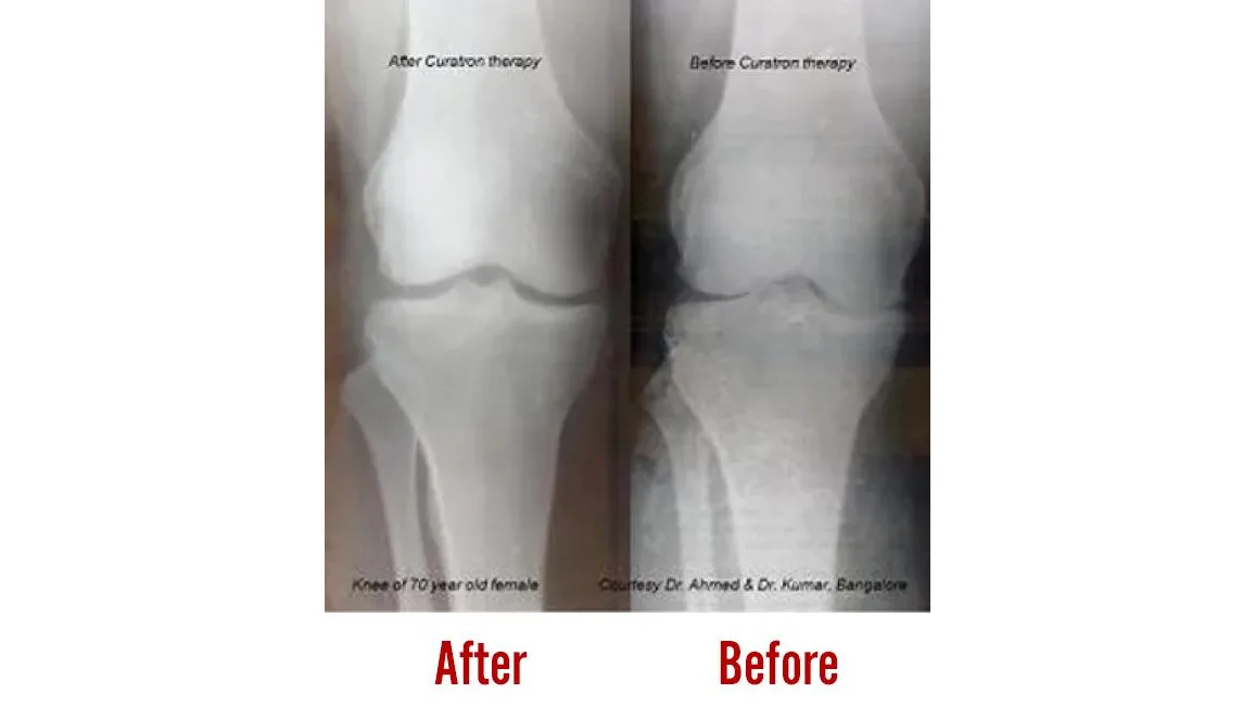 Knee Osteoarthritis and How PEMF Therapy Helps