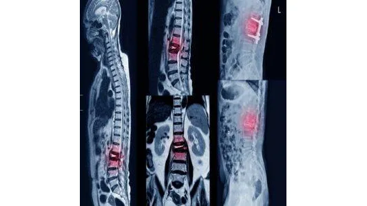 Spinal Cord Injury: Causes, Effects, Rehab, and Veterans