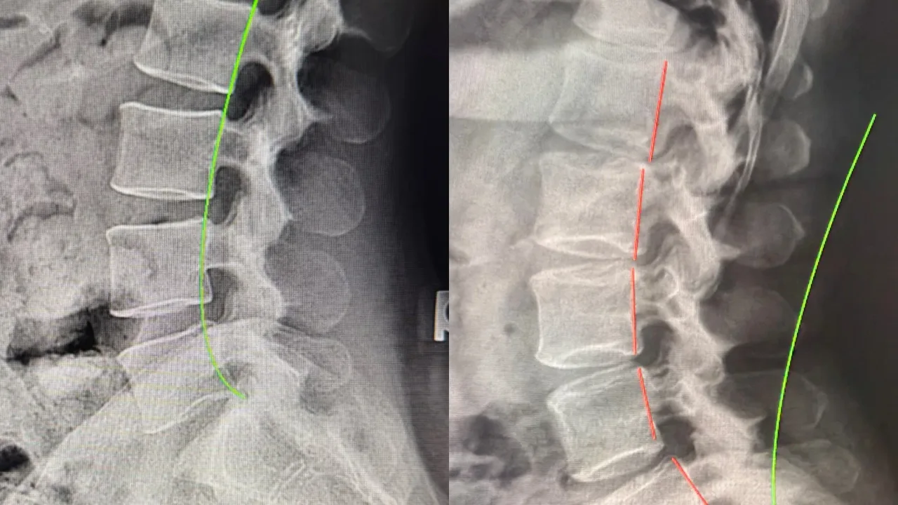 Spinal Stenosis: Causes, Symptoms, and Treatment Options