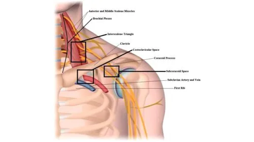 Thoracic Outlet Syndrome: Causes, Symptoms, and Treatment
