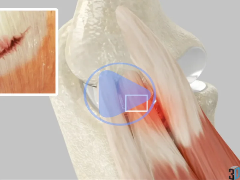 Golfers Elbow — 3D anatomical animation