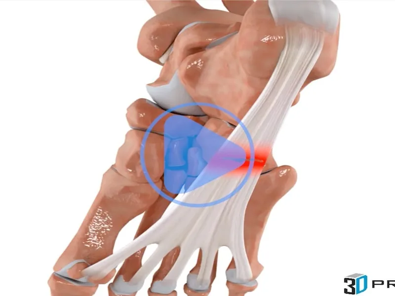 Plantar Fasciitis — 3D anatomical animation